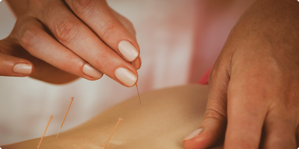 Qu'est-ce que l'acupuncture ?